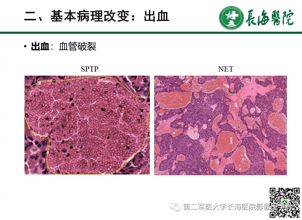 影像PPT - 【PPT】胰腺基本病变：影像与病理-35
