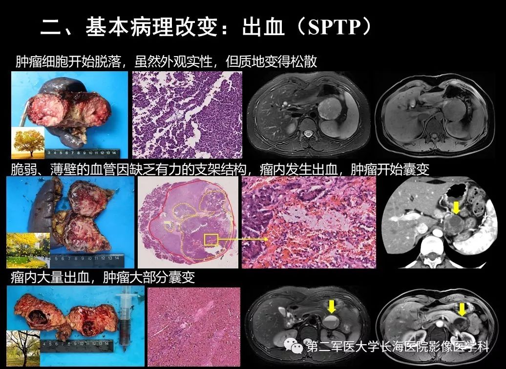 影像PPT - 【PPT】胰腺基本病变：影像与病理-38