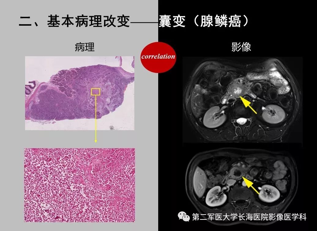 影像PPT - 【PPT】胰腺基本病变：影像与病理-42