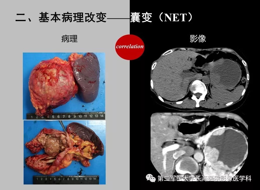 影像PPT - 【PPT】胰腺基本病变：影像与病理-43