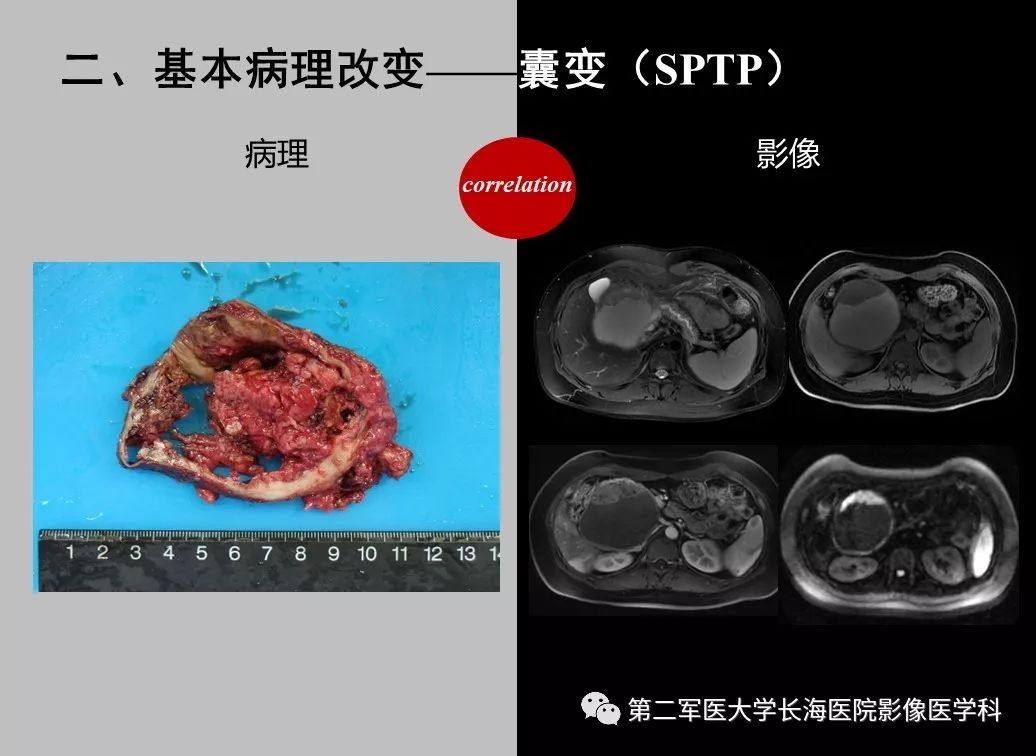 影像PPT - 【PPT】胰腺基本病变：影像与病理-45