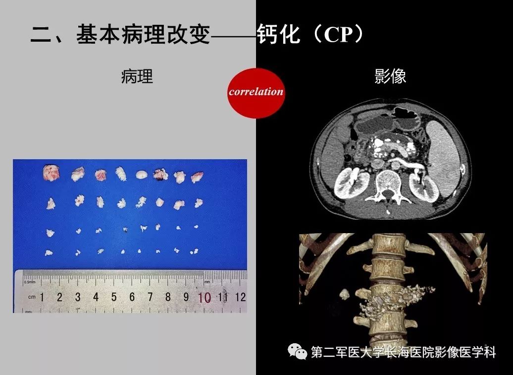 影像PPT - 【PPT】胰腺基本病变：影像与病理-47