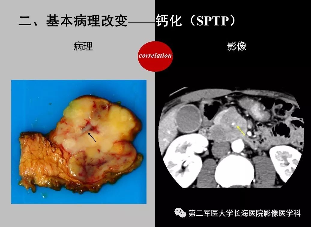 影像PPT - 【PPT】胰腺基本病变：影像与病理-49