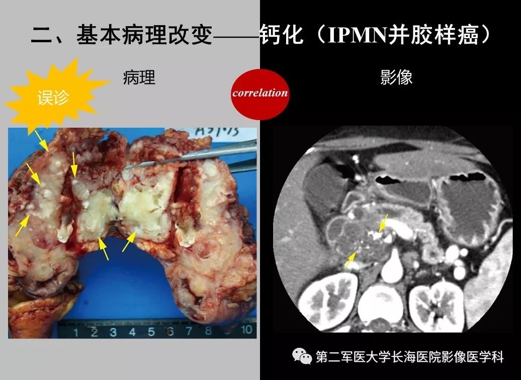 影像PPT - 【PPT】胰腺基本病变：影像与病理-50