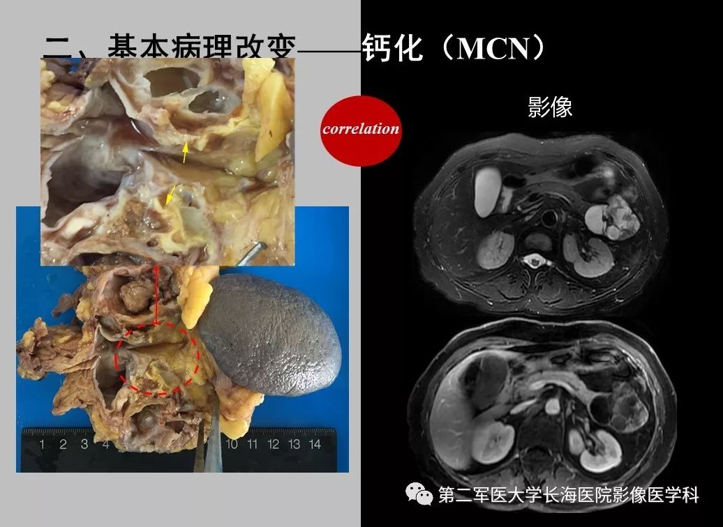 影像PPT - 【PPT】胰腺基本病变：影像与病理-51