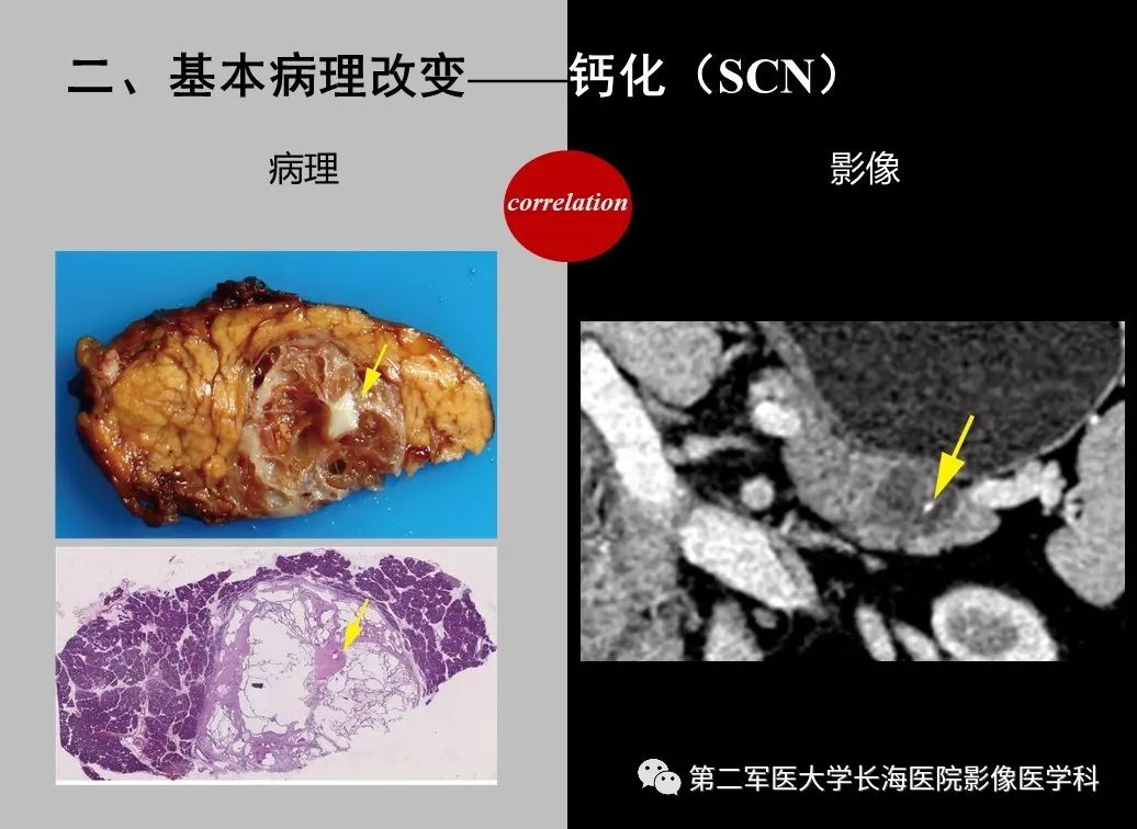 影像PPT - 【PPT】胰腺基本病变：影像与病理-52