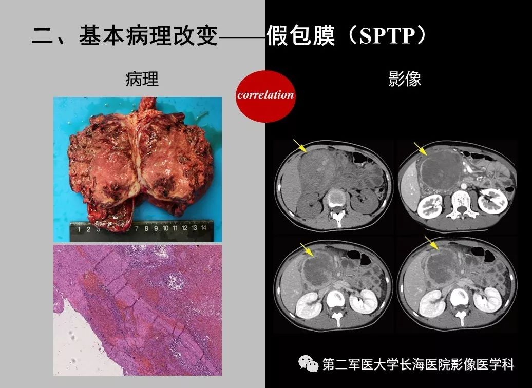 影像PPT - 【PPT】胰腺基本病变：影像与病理-55