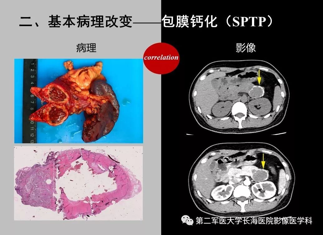 影像PPT - 【PPT】胰腺基本病变：影像与病理-57