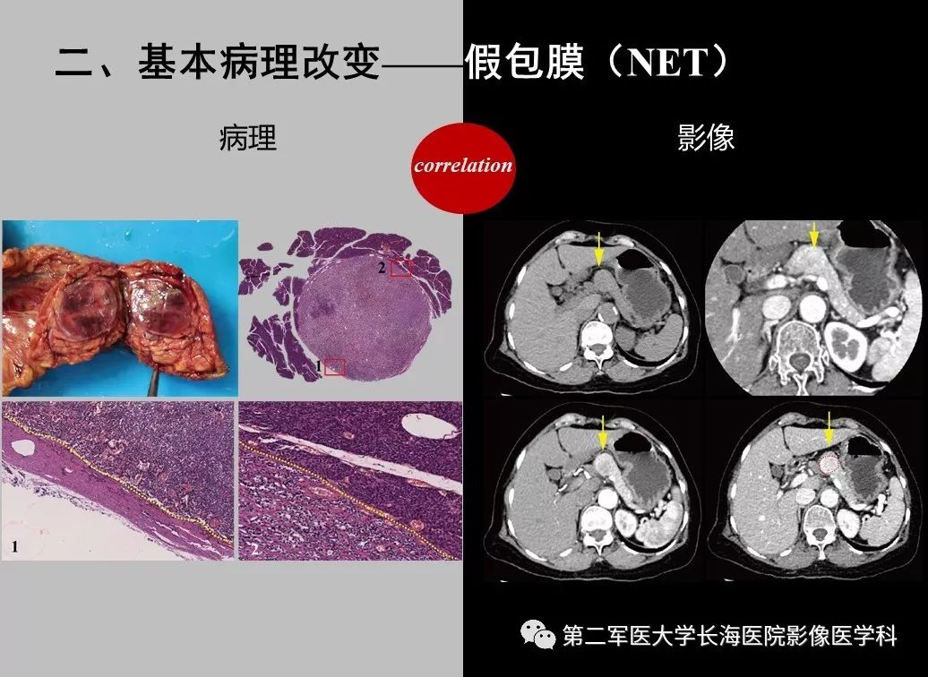 影像PPT - 【PPT】胰腺基本病变：影像与病理-56