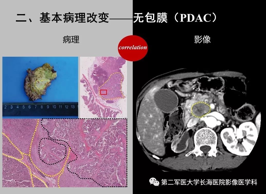 影像PPT - 【PPT】胰腺基本病变：影像与病理-58