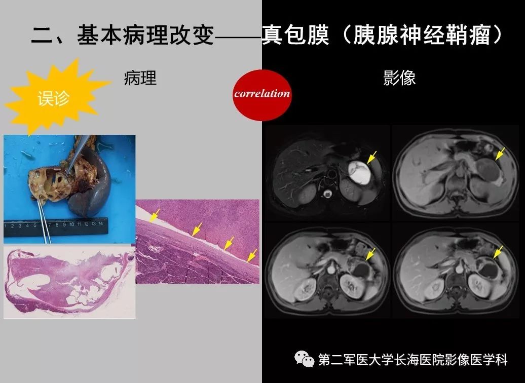 影像PPT - 【PPT】胰腺基本病变：影像与病理-59