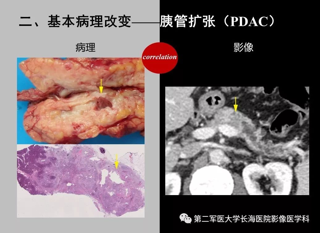影像PPT - 【PPT】胰腺基本病变：影像与病理-66
