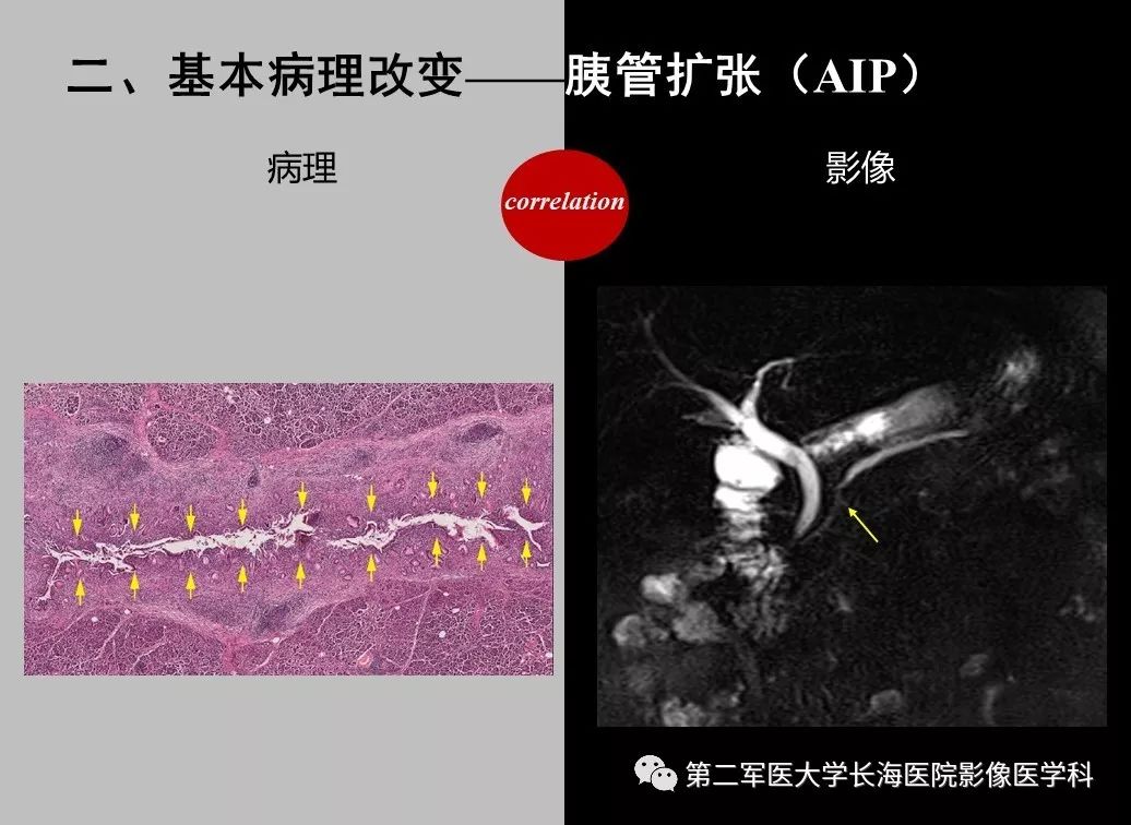 影像PPT - 【PPT】胰腺基本病变：影像与病理-65