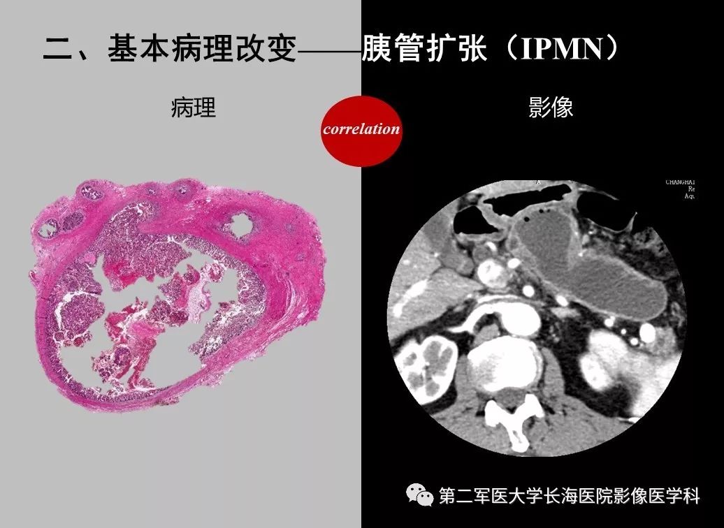 影像PPT - 【PPT】胰腺基本病变：影像与病理-67