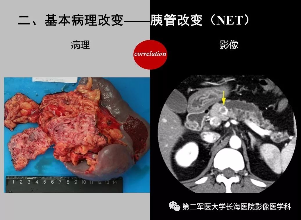 影像PPT - 【PPT】胰腺基本病变：影像与病理-68
