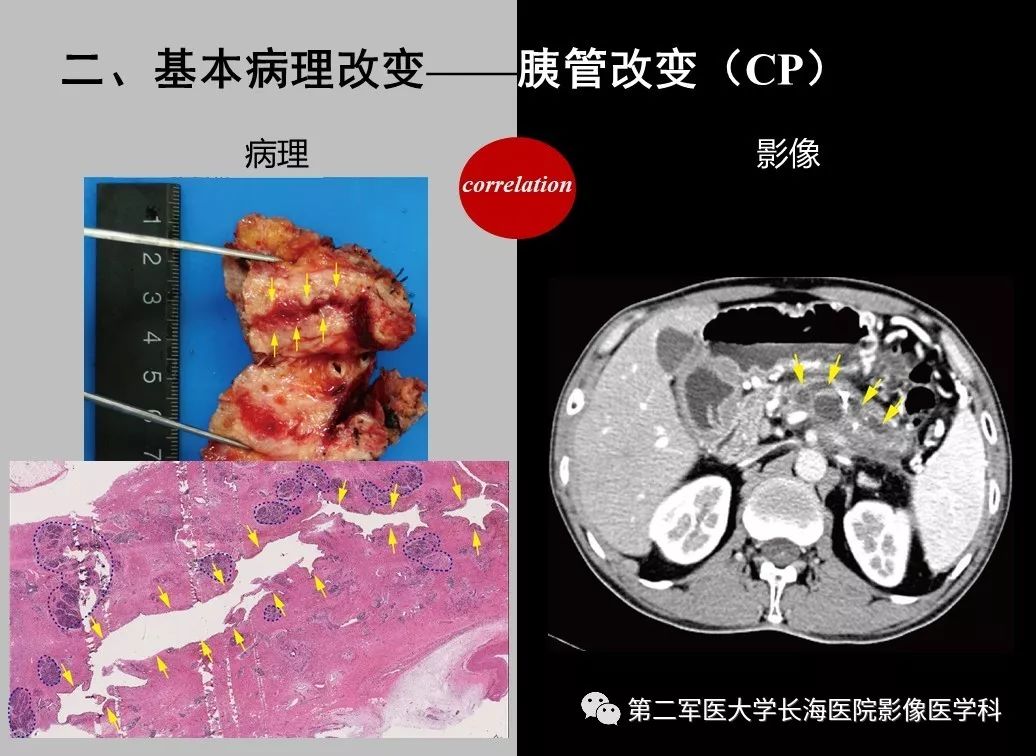影像PPT - 【PPT】胰腺基本病变：影像与病理-63