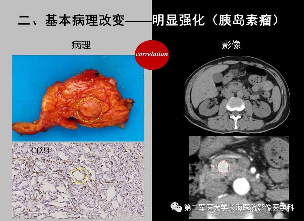 影像PPT - 【PPT】胰腺基本病变：影像与病理-73