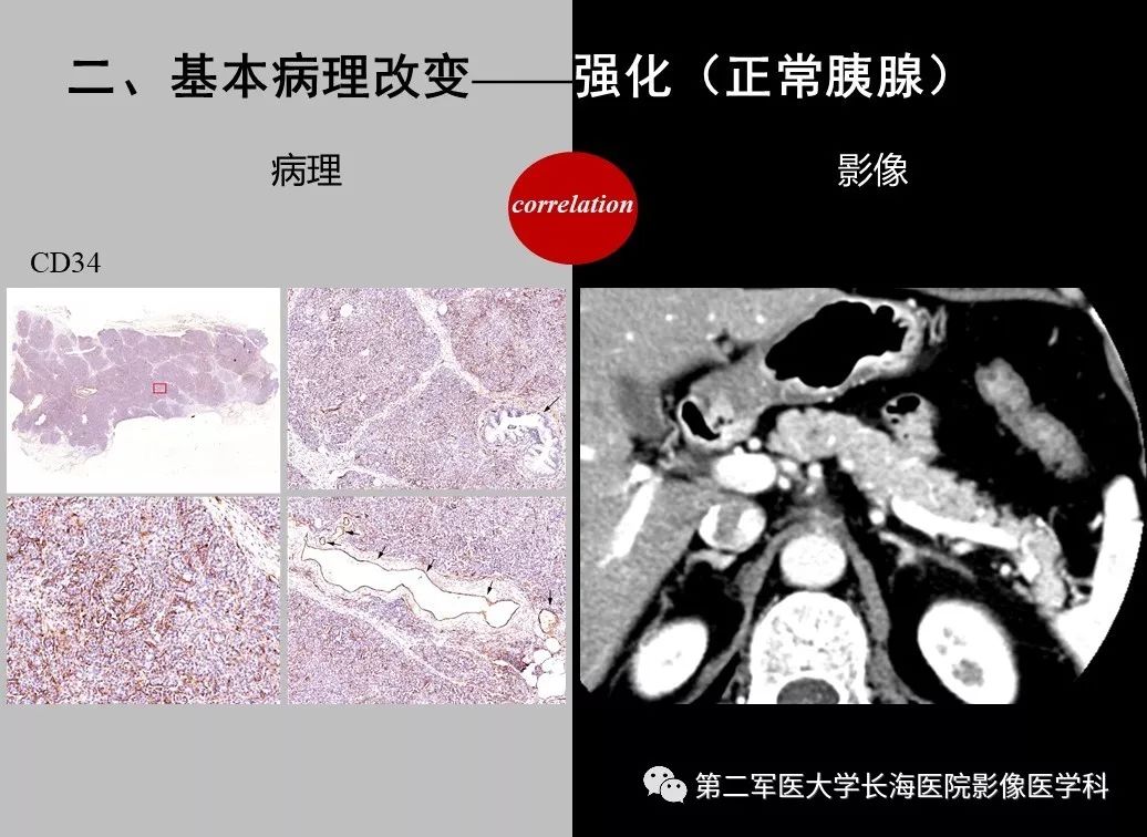 影像PPT - 【PPT】胰腺基本病变：影像与病理-72