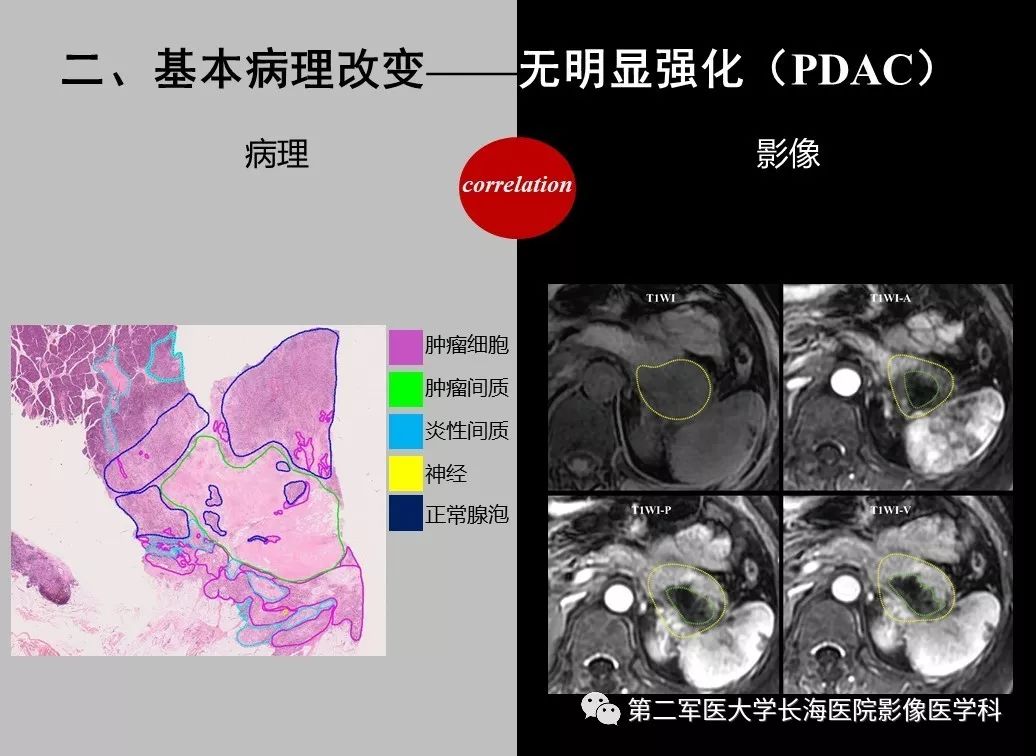 影像PPT - 【PPT】胰腺基本病变：影像与病理-75