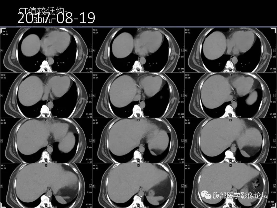 影像PPT - 【病例】肝脏透明细胞癌1例CT及MR-3