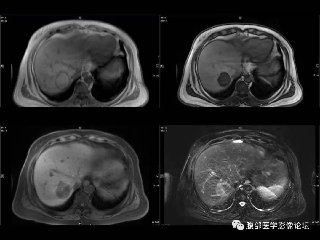 影像PPT - 【病例】肝脏透明细胞癌1例CT及MR-8