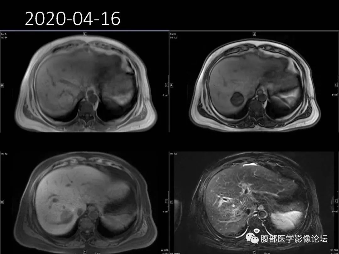 影像PPT - 【病例】肝脏透明细胞癌1例CT及MR-7