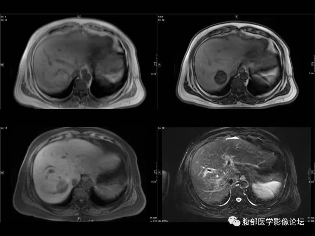 影像PPT - 【病例】肝脏透明细胞癌1例CT及MR-10