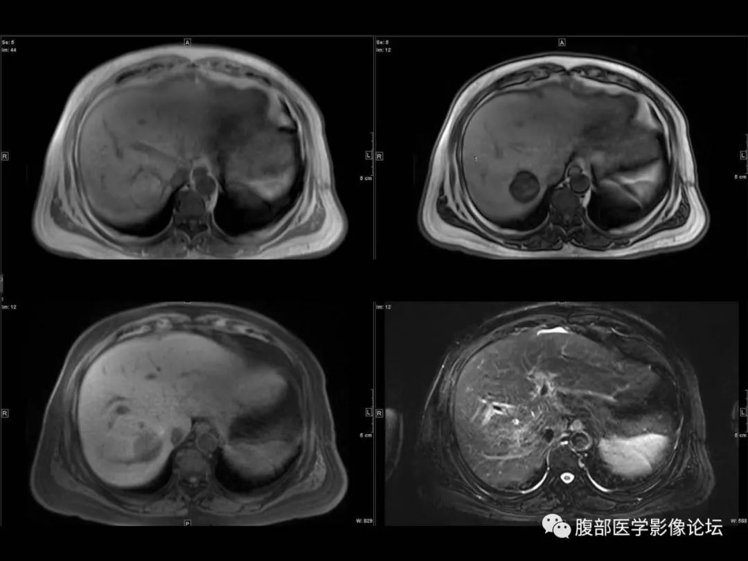 影像PPT - 【病例】肝脏透明细胞癌1例CT及MR-9