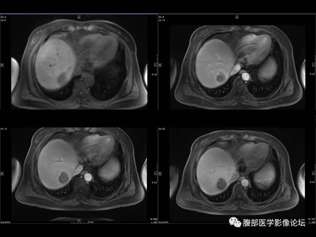 影像PPT - 【病例】肝脏透明细胞癌1例CT及MR-11