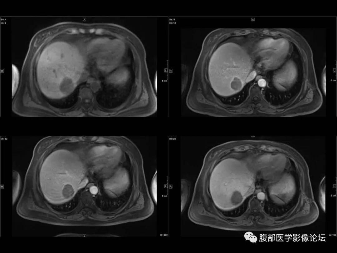 影像PPT - 【病例】肝脏透明细胞癌1例CT及MR-12