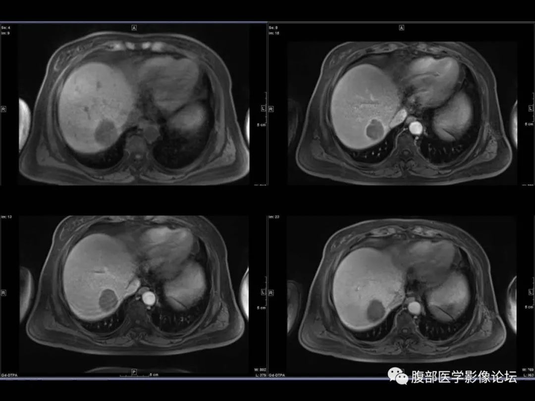 影像PPT - 【病例】肝脏透明细胞癌1例CT及MR-13