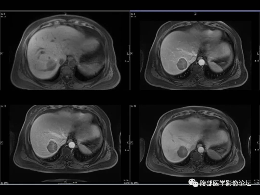 影像PPT - 【病例】肝脏透明细胞癌1例CT及MR-14