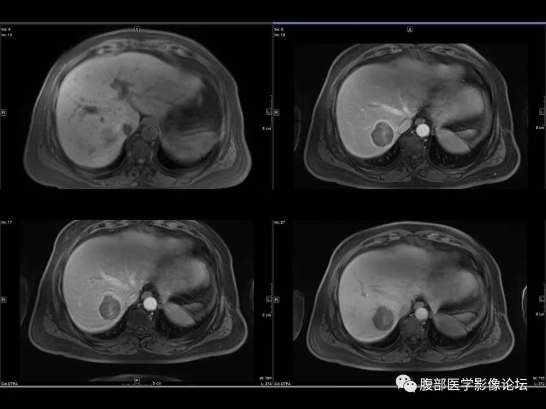 影像PPT - 【病例】肝脏透明细胞癌1例CT及MR-15