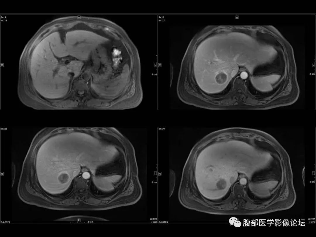 影像PPT - 【病例】肝脏透明细胞癌1例CT及MR-17