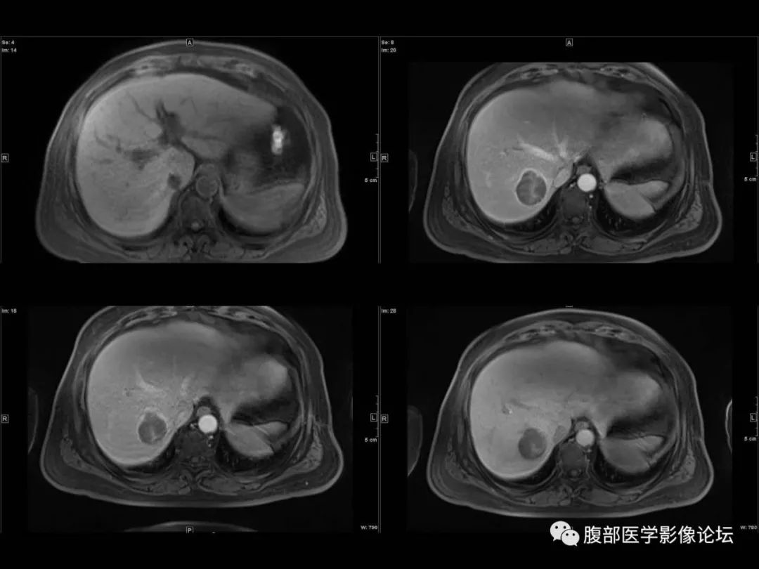 影像PPT - 【病例】肝脏透明细胞癌1例CT及MR-16