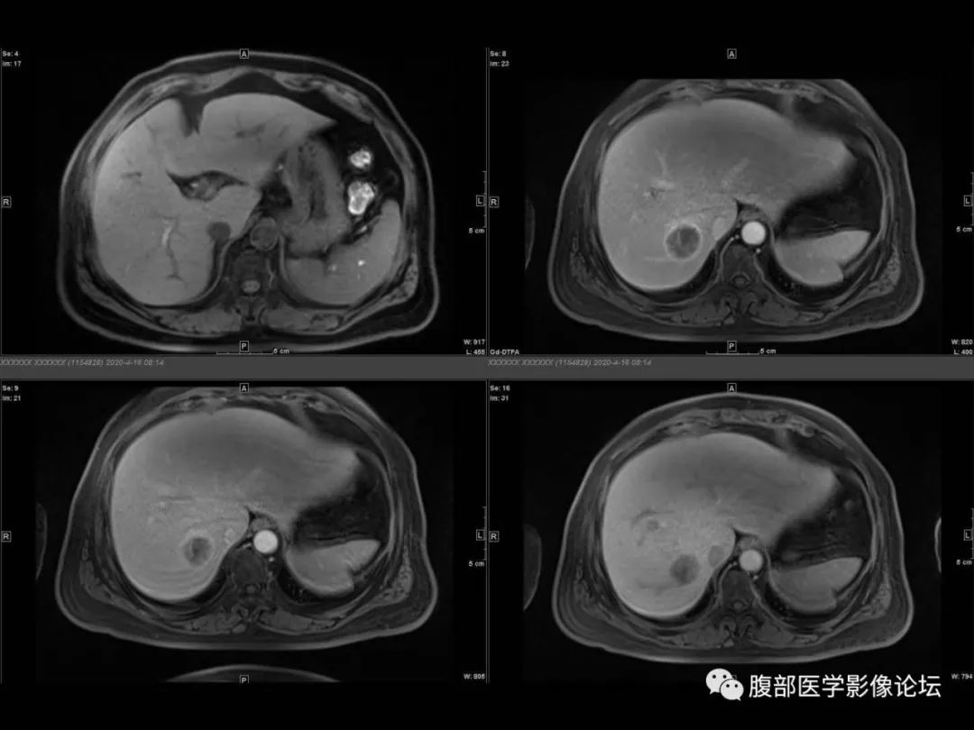 影像PPT - 【病例】肝脏透明细胞癌1例CT及MR-18