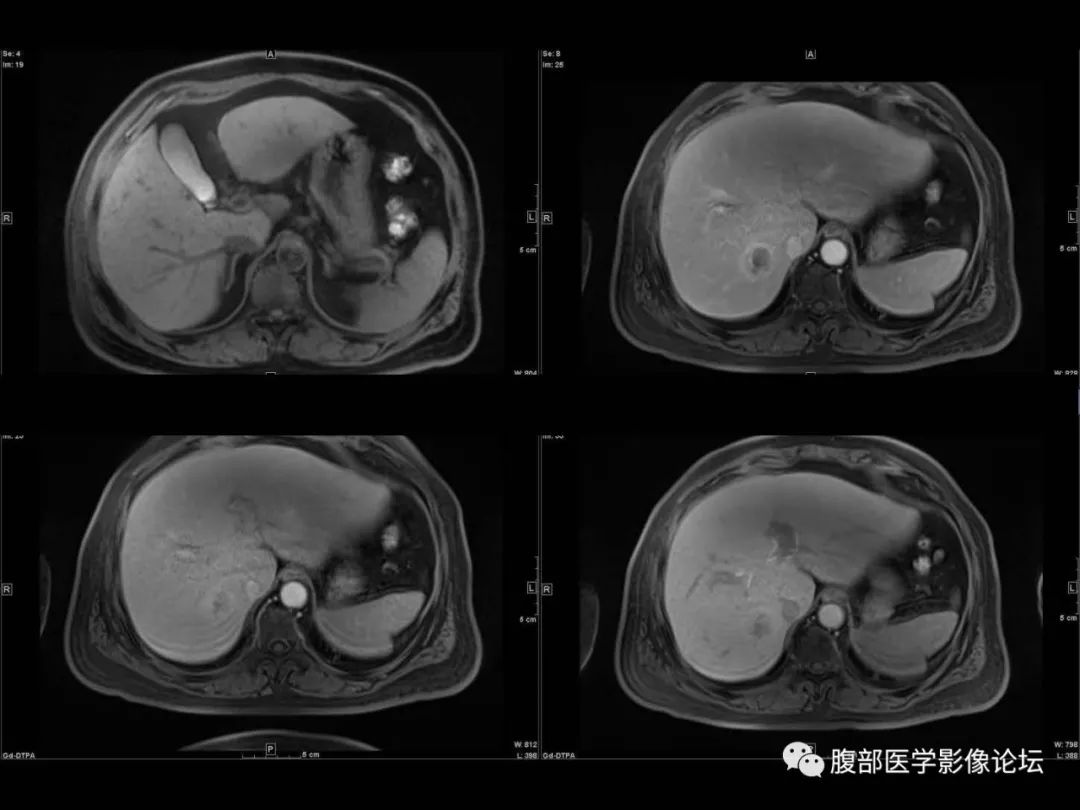 影像PPT - 【病例】肝脏透明细胞癌1例CT及MR-19