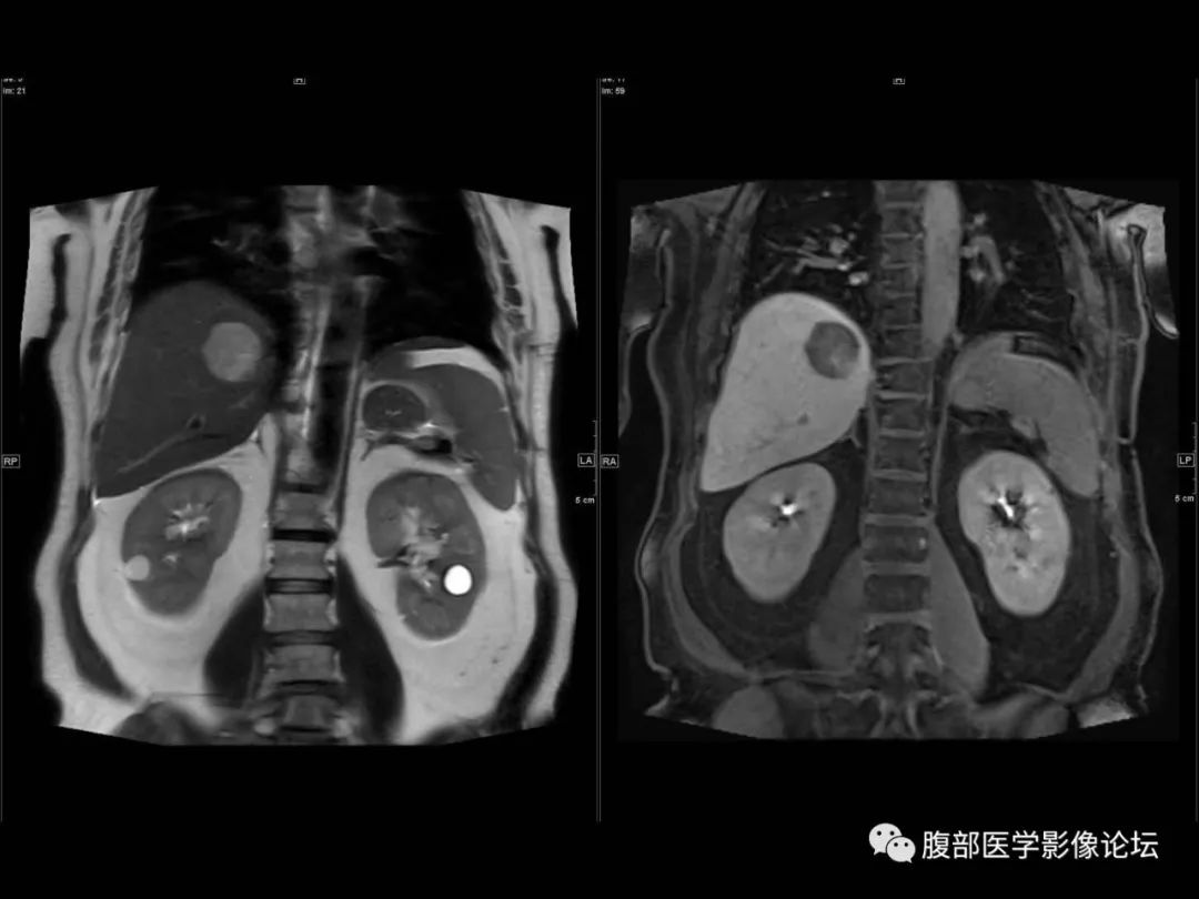 影像PPT - 【病例】肝脏透明细胞癌1例CT及MR-20