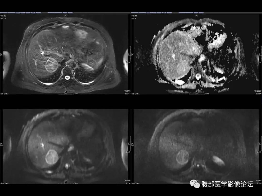 影像PPT - 【病例】肝脏透明细胞癌1例CT及MR-21