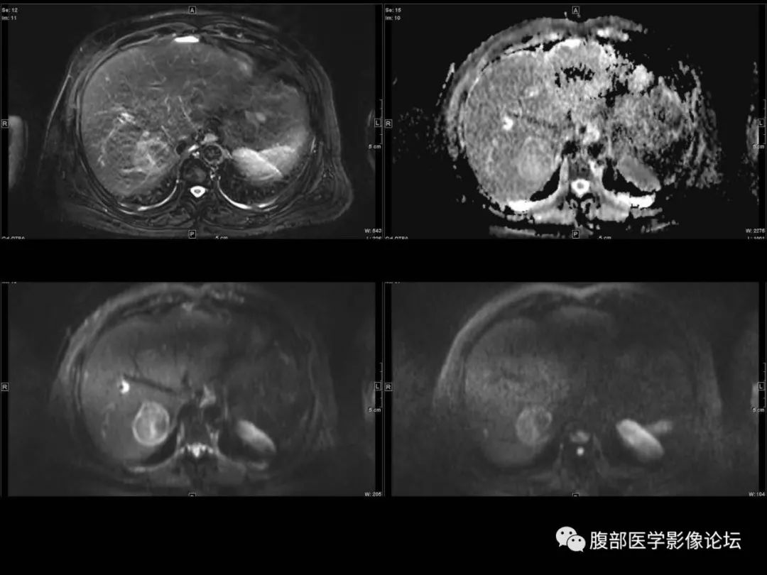 影像PPT - 【病例】肝脏透明细胞癌1例CT及MR-22