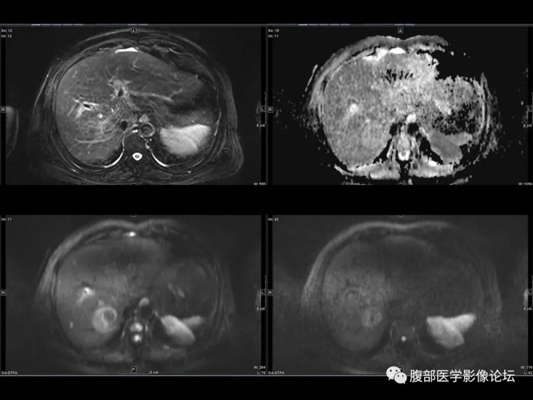 影像PPT - 【病例】肝脏透明细胞癌1例CT及MR-23