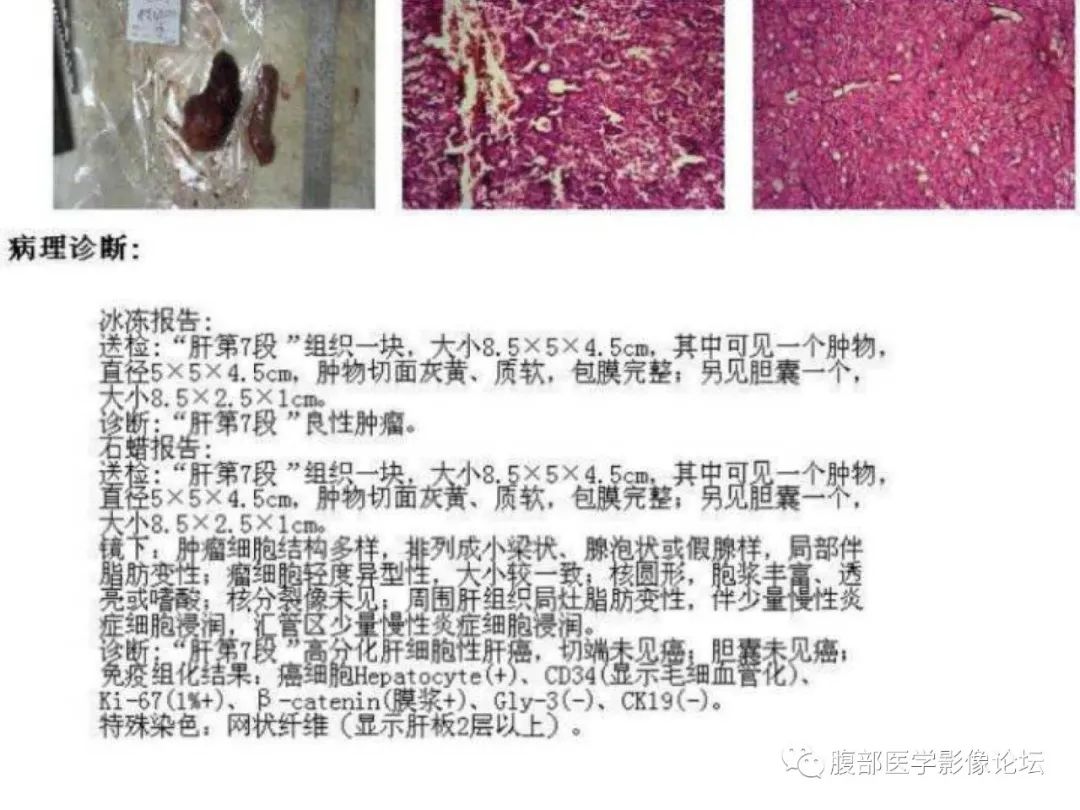 影像PPT - 【病例】肝脏透明细胞癌1例CT及MR-24
