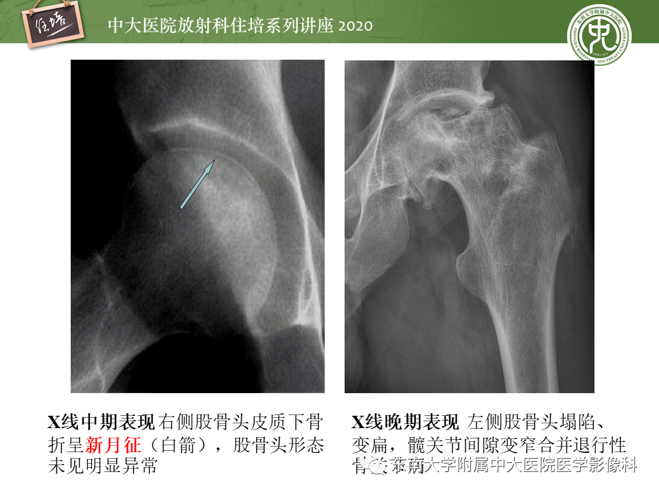 影像PPT - 【PPT】骨缺血坏死性病变的影像学特征-11