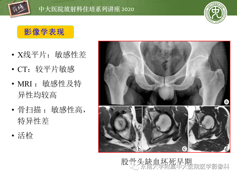 影像PPT - 【PPT】骨缺血坏死性病变的影像学特征-9