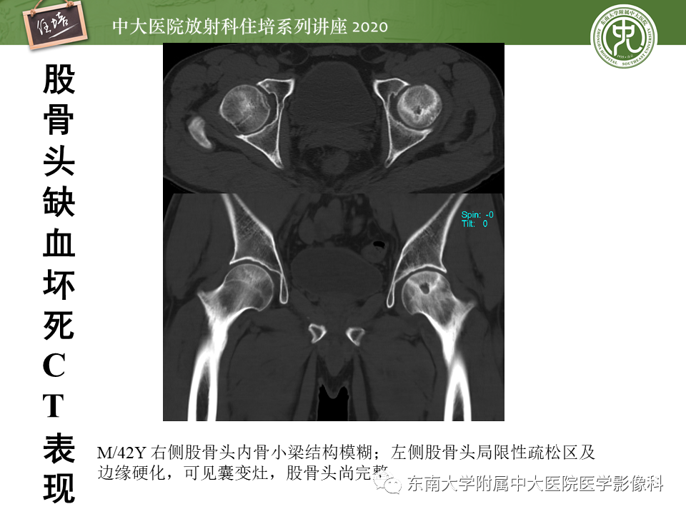 影像PPT - 【PPT】骨缺血坏死性病变的影像学特征-14