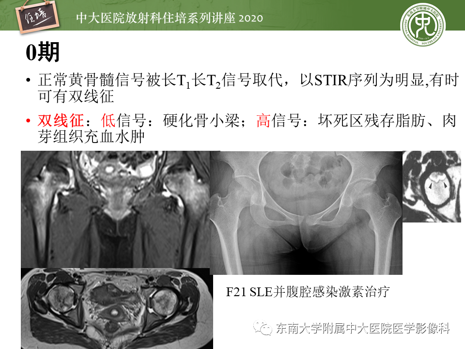 影像PPT - 【PPT】骨缺血坏死性病变的影像学特征-17