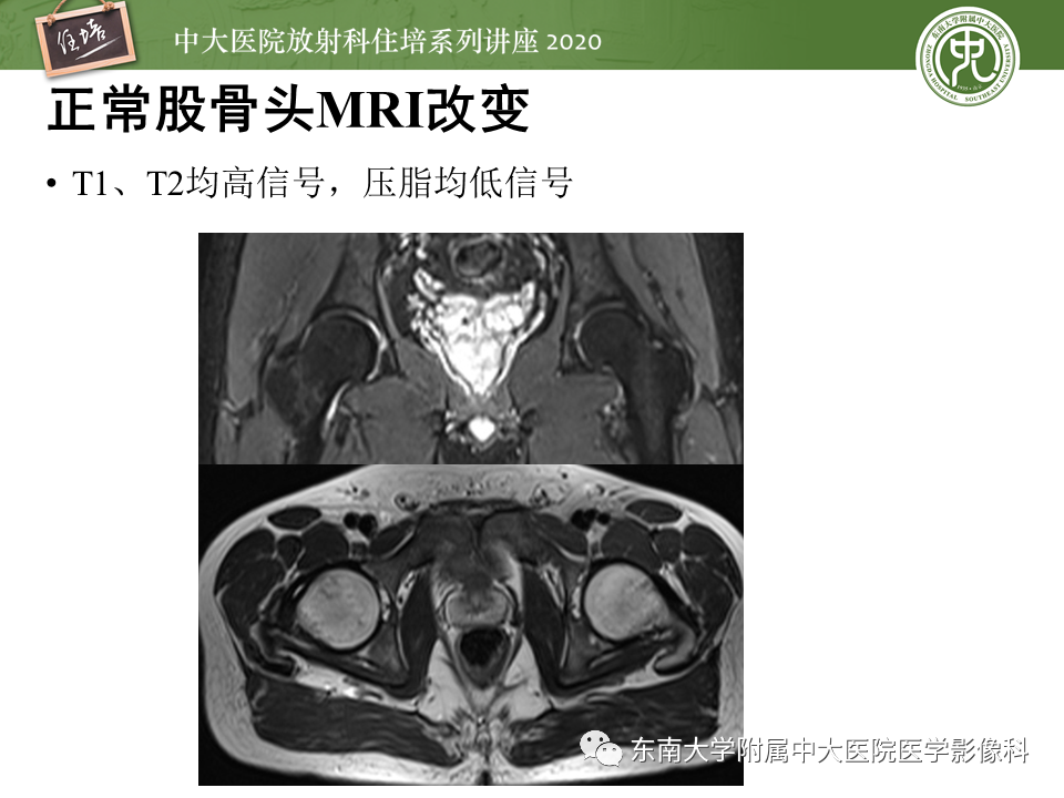 影像PPT - 【PPT】骨缺血坏死性病变的影像学特征-16