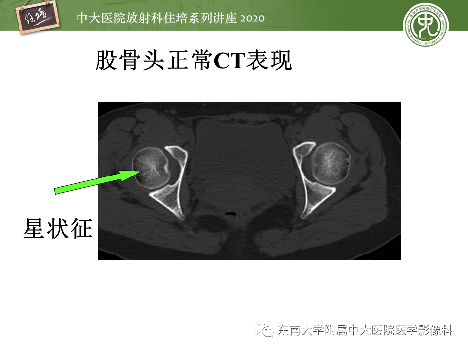 影像PPT - 【PPT】骨缺血坏死性病变的影像学特征-13