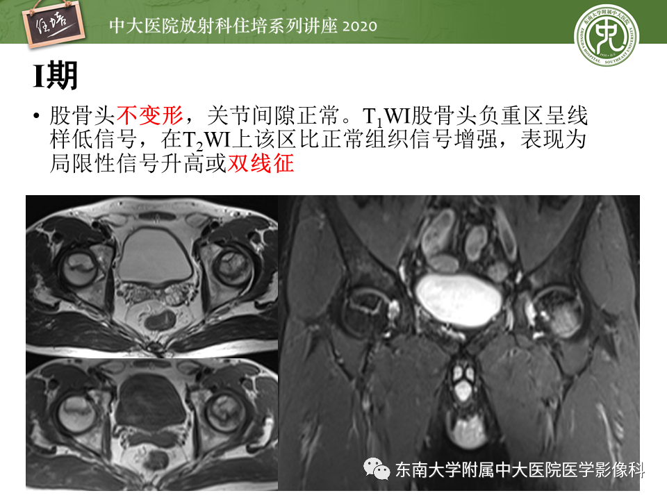影像PPT - 【PPT】骨缺血坏死性病变的影像学特征-18