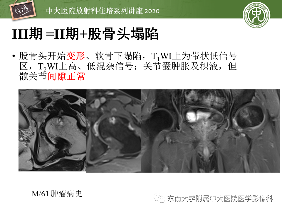影像PPT - 【PPT】骨缺血坏死性病变的影像学特征-21